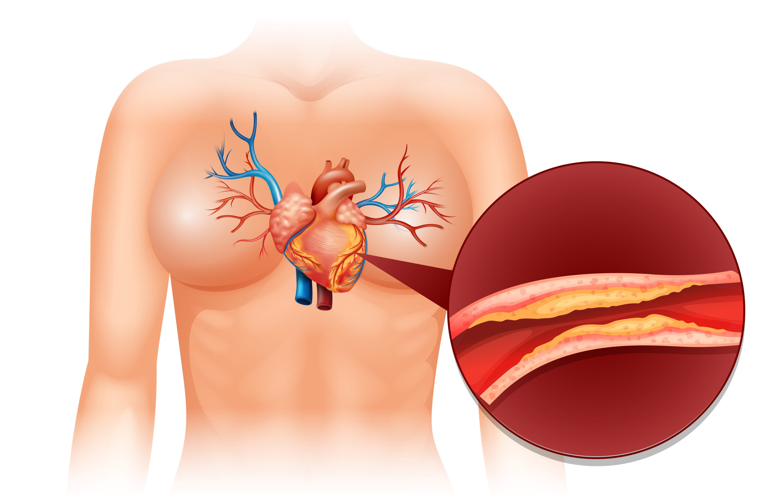 High Cholesterol Symptoms in Men: 1 Ultimate Guide to You